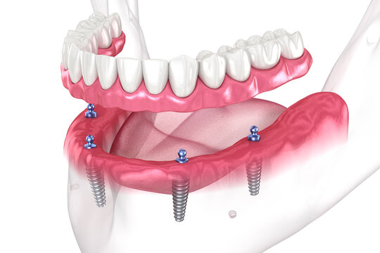 All-on-4 Implants Dental Solution