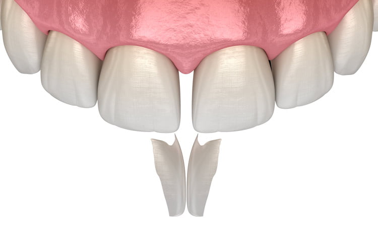 Composite Bonding Procedure