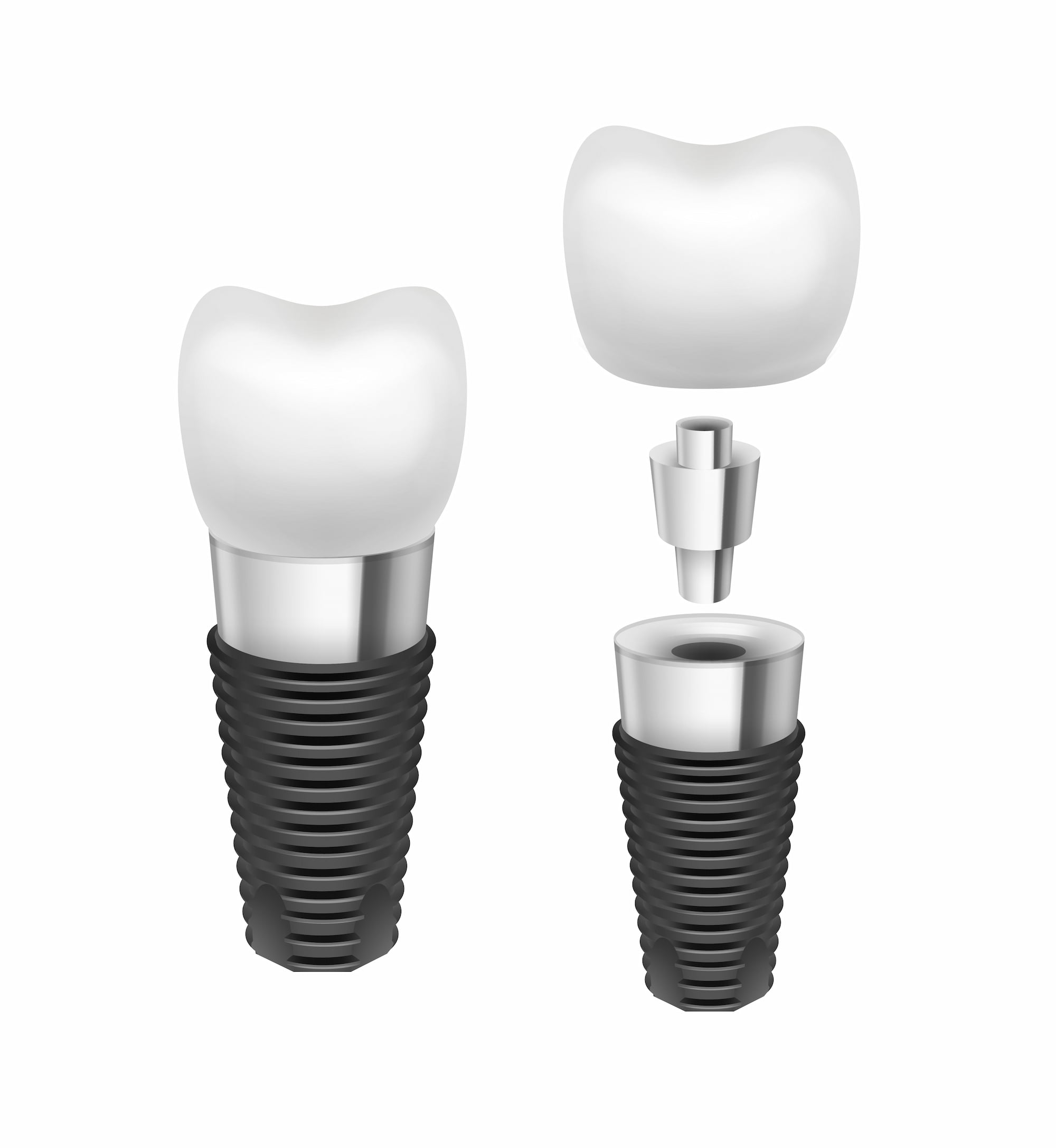 Dental Implant Info Image