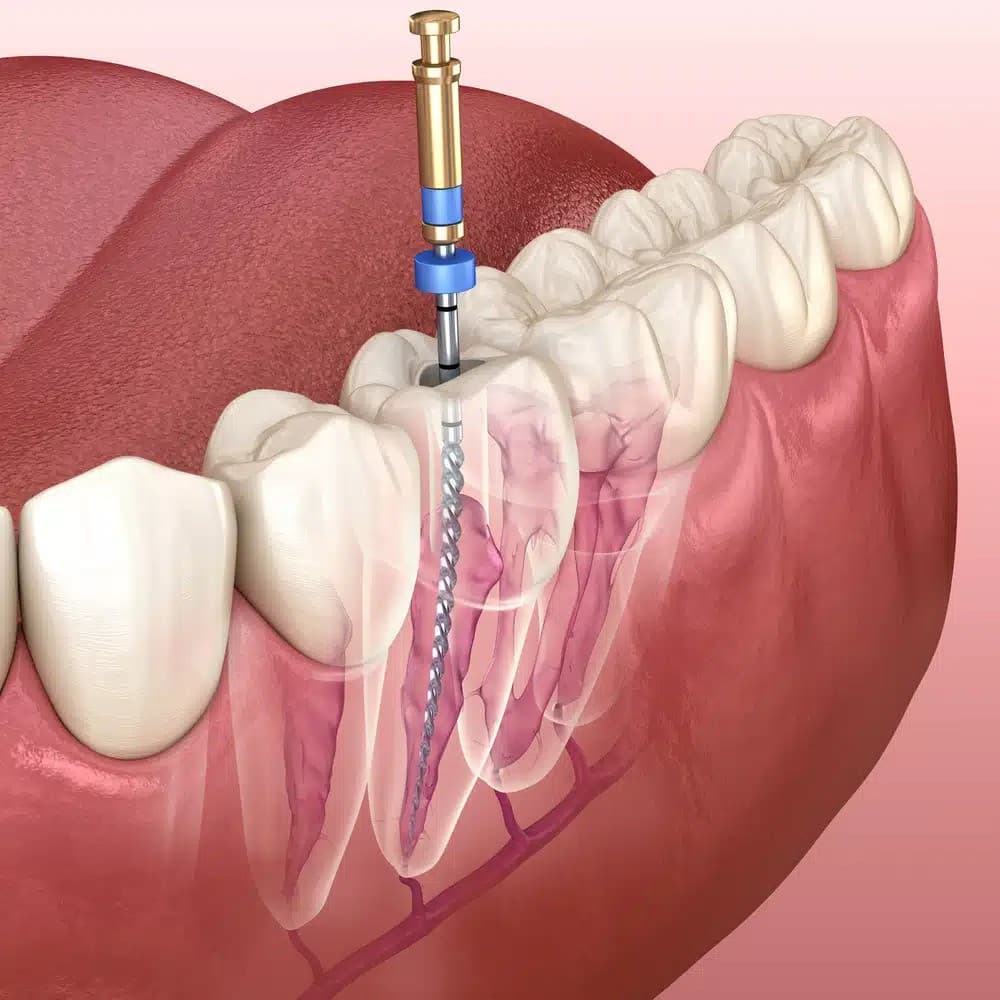 What is a Root Canal?