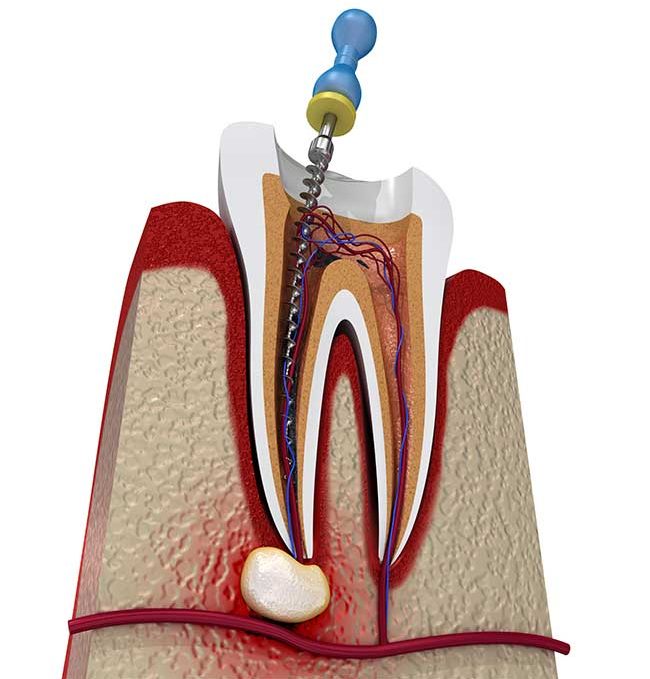 When is Root Canal Needed?