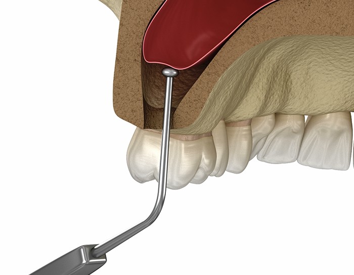 What is Sinus Lifting?