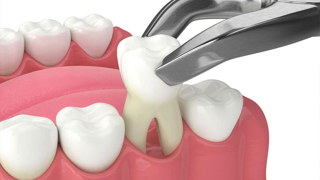 What is Tooth Extraction?